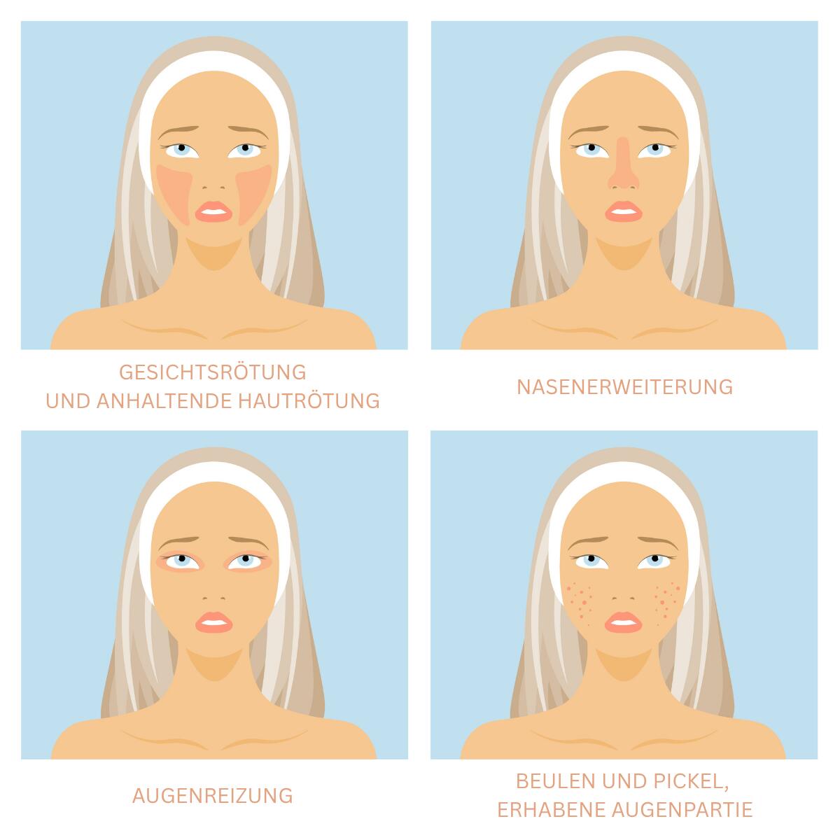 Illustration mit vier Darstellungen eines Gesichts, die typische Rosacea-Symptome zeigen: flächige Rötungen auf den Wangen, vergrößerte Nase, gereizte Augen sowie rote Papeln und Pusteln auf den Wangen..